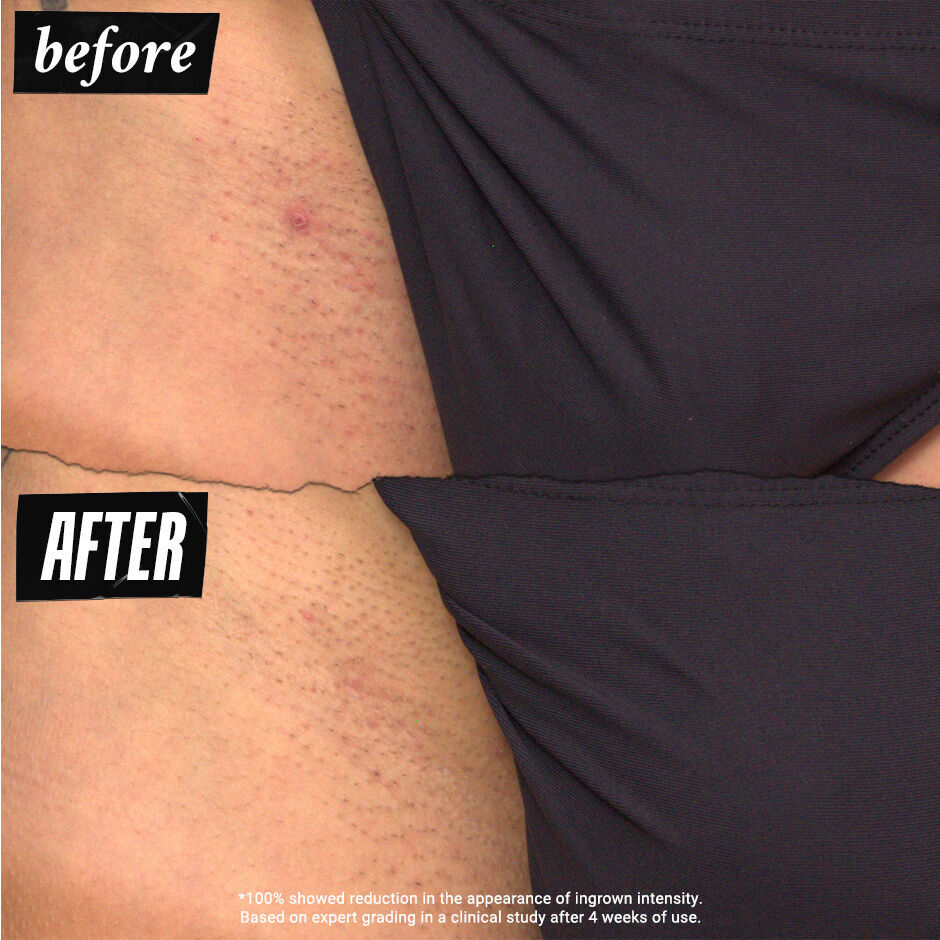 私密理毛修護美白精華 – 私密處保養推薦/理毛保養/美白精華