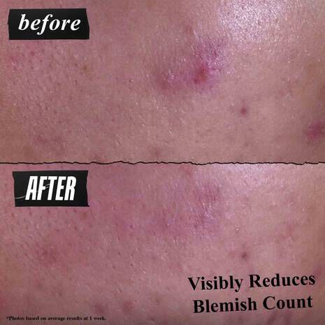 2%水楊酸三合一淨痘潔膚乳 全臉背適用＆根源制痘不復發