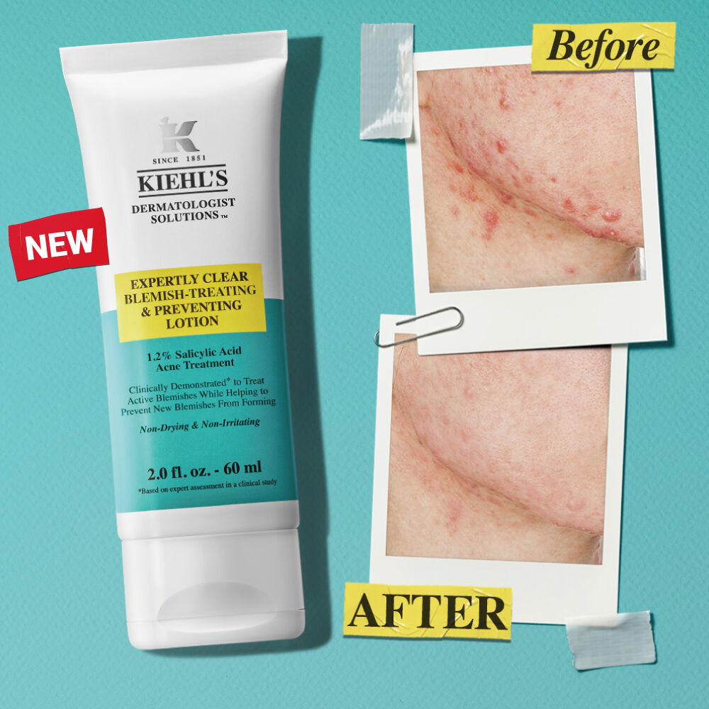 1.2%水楊酸涼感痘痘凝膠－抗痘救星／全臉背適用＆根源制痘不復發