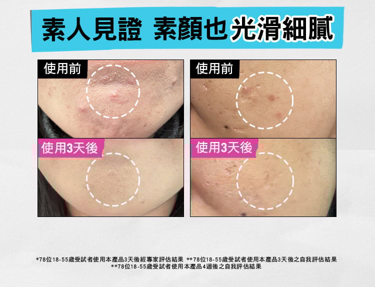 激光三酸煥膚精華液