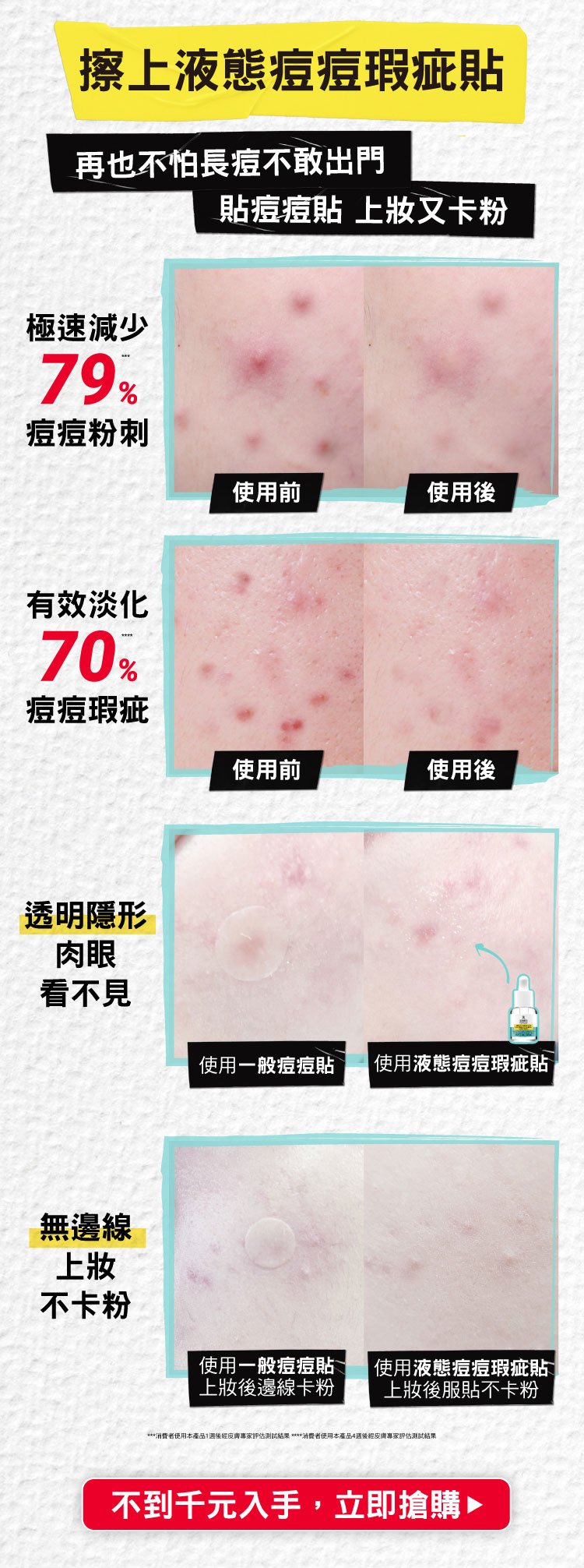 再也不怕長痘不敢出門 貼痘痘貼 上妝又卡粉
