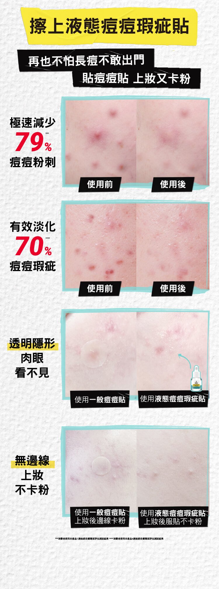 再也不怕長痘不敢出門 貼痘痘貼 上妝又卡粉