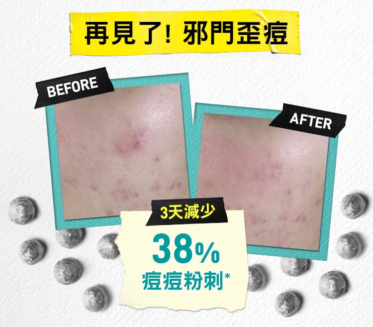 2%水楊酸三合一淨痘潔膚乳